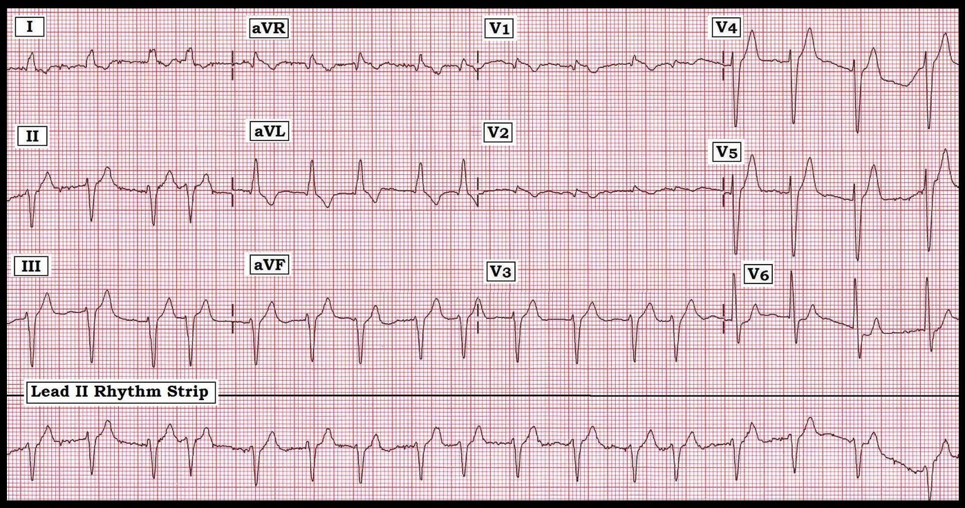 ekg